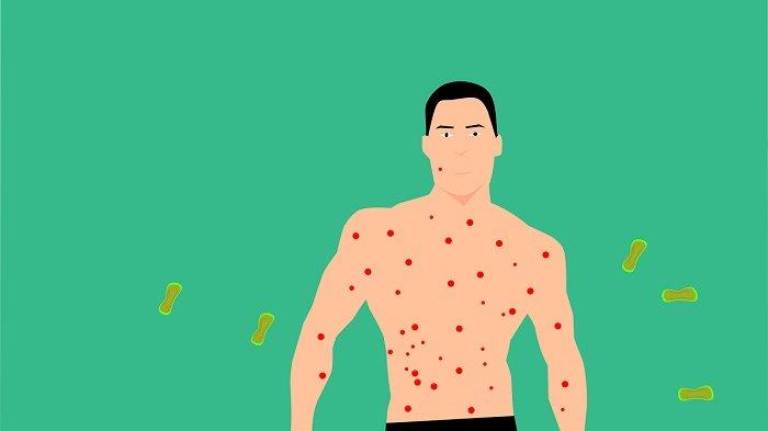 Pemerintah RI Waspadai Mpox Jelang IAF Bali dan Aturan Vaksinasi