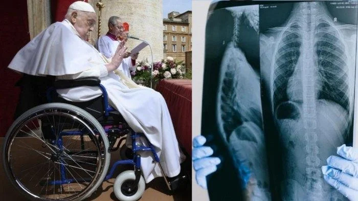 Pneumonia Bilateral yang Diidap Paus Fransiskus: Gejala, Penyebab, dan Risiko