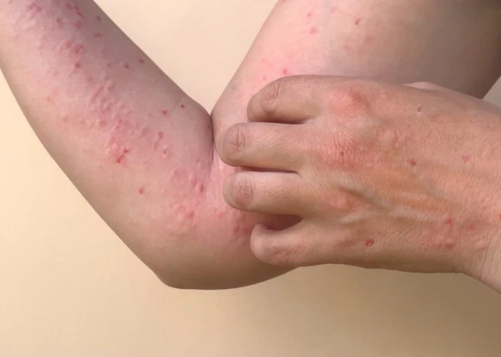 Dinkes Riau: Kasus Suspek Monkeypox Masih Dalam Penyelidikan